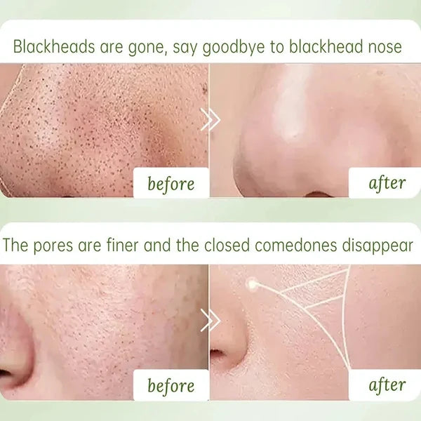 Beautyturess Kompleksa Acida Tea-Ŝlima Vezika Masko (8g x 16 strioj)